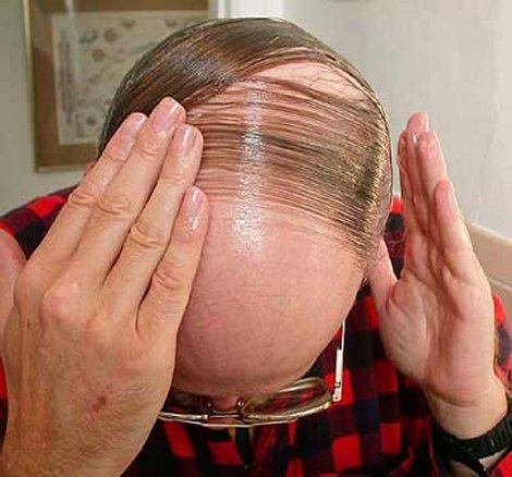 Suffering From Male Pattern Baldness? Here's Some Help